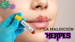 Herpes y cómo se propaga Tratamiento y prevención herpeszoster enfermedades síntomas [upl. by Aufa]