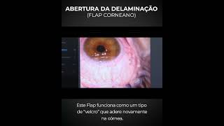 Como é feita a Cirurgia Refrativa a Laser para a correção da Miopia Hipermetropia e Astigmatismo [upl. by Cathrin]