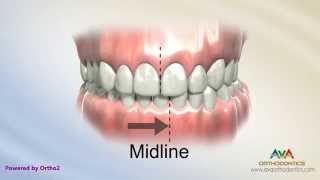 Orthodontic Treatment for Narrow Upper Jaw with Functional Shift  Expander or Spacer [upl. by Eloise]