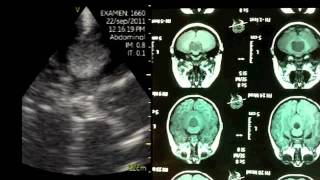 VSCAN Intraoperative quotpocketquot ultrasound Cerebellar Vermis Medulloblastoma [upl. by Klump]