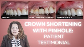 Crown Shortening with Pinhole Patient testimonials [upl. by Gore]