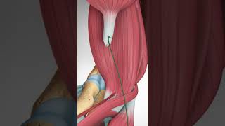 Distal Biceps Tendon Rupture and Repair bicepstendon elbowpain biceps [upl. by Akenahc213]