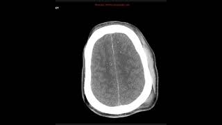 Diffuse axonal InjuryCases [upl. by Claiborne958]