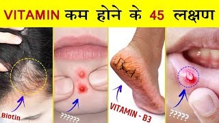 ये 45 लक्षण को भूलकर भी नजरअंदाज मत करना  शरीर में Vitamins और Minirals कम होने के संकेत [upl. by Remat514]