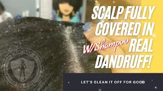 2MuchHair Full Dandruff Treatment w Dry Scratches an Shampoo asmr [upl. by Ttessil430]