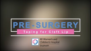 PreSurgery Taping for Cleft Lip [upl. by Christmas]