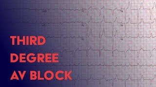 Third Degree Complete Heart Block  EKG ECG Interpretation [upl. by Ibbed]