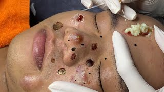 blackheads new 2023  popping pimple today  blackheads and whiteheads removal [upl. by Falda742]