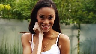 How a Model with Vitiligo Ignored Bullies and Became an Inspiration to All [upl. by Conn]