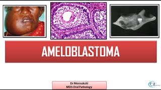 Ameloblastoma  Benign Odontogenic Tumor [upl. by Rodd347]