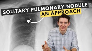 My approach to solitary pulmonary nodules [upl. by Timothy34]