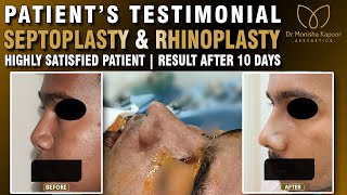 Correction Deviated Septum Septoplasty  Rhinoplasty Nose Before and After Result Dr Monisha Kapoor [upl. by Akeim550]