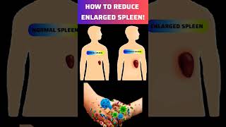 How To Treat Enlarged Spleen  How To Reduced Enlarged Spleen spleen [upl. by Nossaj663]