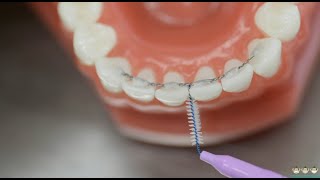 How to use interdental brushes under fixed retainer wire  Evolution Orthodontics [upl. by Madi146]