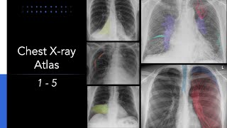 Chest Xray Atlas 5 Essential Chest Xrays for Students [upl. by Consuela761]