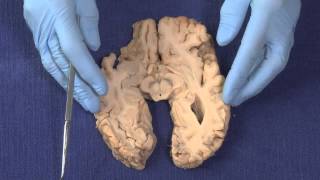 Basal Ganglia Neuroanatomy Video Lab  Brain Dissections [upl. by Barbuto]