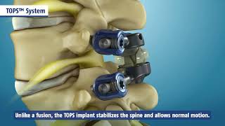 TOPS System  Cures Lumbar Spinal Stenosis Spondylolisthesis [upl. by Nannoc567]