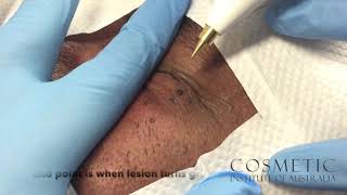 dermatosis papulosa nigra removal with radio frequency [upl. by Meg]