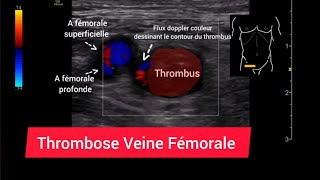 Thrombose Veineuse Fémorale Phlébite Échographie Doppler [upl. by Derr761]