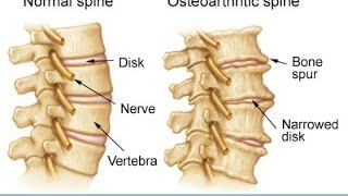 Anatomy of Spinal Arthritis Explained by Top Pain Doctor in Las Vegas Nevada [upl. by Singer]