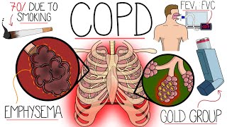 Understanding Chronic Obstructive Pulmonary Disease COPD Explained Clearly [upl. by Osrit257]