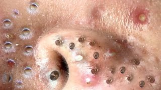 Best Pimple Popping Videos 2021  Blackheads Removal 021 [upl. by Aicatsanna]