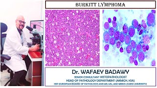 BURKITT LYMPHOMA BY DR WAFAEY BADAWY [upl. by Sisile]