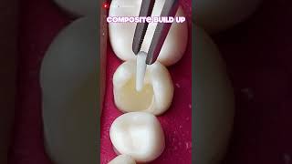 Onlay Teeth Restoration dentistteeth satisfying [upl. by Nairbo950]