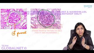 NEPHRITIC SYNDROME By Dr Illa jain khandelwal Pathology by Marrow Video Lecture [upl. by Ilrebmik]