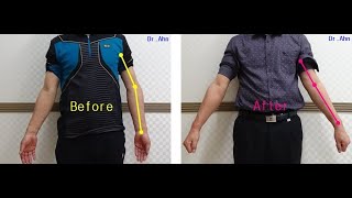 Arm motion after Lt cubitus varus surgeryelbow varus deformity [upl. by Baldwin730]