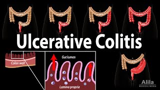 Ulcerative Colitis Pathophysiology Symptoms Risk factors Diagnosis and Treatments Animation [upl. by Carolina]