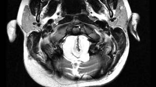 Spinal Lipoma Cervical [upl. by Minica]