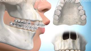 Extractions de dents pour correction surplomb horizontal [upl. by Ihpen]