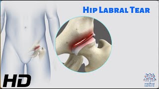 Hip Labral Tear The Hidden Culprit of Hip Pain [upl. by Kcirddes99]