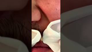 Extraction de Point Noir Ultra Rapide  🖤acne blackheads ytshorts [upl. by Zhang]