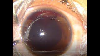 Traumatic Hyphema  Hyphemectomy Under Topical Anesthesia Unedited HD [upl. by Langham]