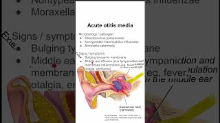 Acute otitis media [upl. by Clarabelle]