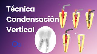 Técnica de Condensación Vertical 🦷 en Endodoncia [upl. by Grose]