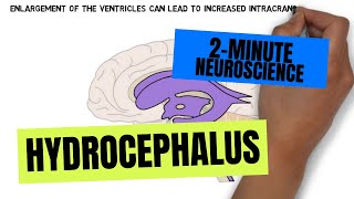 2Minute Neuroscience Hydrocephalus [upl. by Nussbaum]