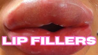 LIP FILLERS What are the risks [upl. by Wenonah]