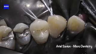 Restoring Teeth without Root Canal Treatment Effective Caries Removal and Crown Restoration [upl. by Noj20]