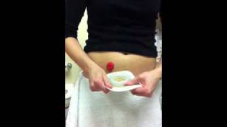 Ostomy pouch change using ConvaTec moldable [upl. by Akinihs]