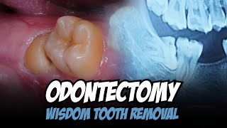 ODONTECTOMY  PENCABUTAN GERAHAM BUNGSU  Dentist  Dokter Gigi Tri Putra [upl. by Bouton306]