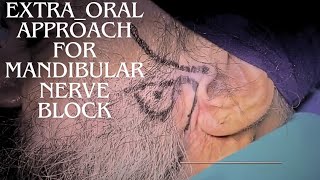 Extraoral Technique for Mandibular Nerve Block [upl. by Longtin]