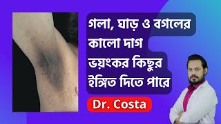 ঘাড় ও বগলের কালো দাগের ভয়াবহতা  Dr Costa [upl. by Idihsar78]