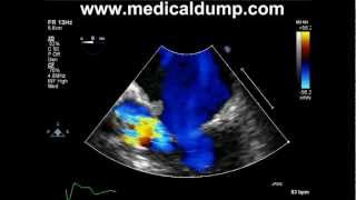 Mitral Valve Endocarditis  TransEsophageal Echocardiogram TEE [upl. by Tnerb614]