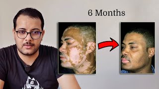 OPZELURA  Ruxolitinib  finally a cure for VITILIGO [upl. by Irianat]