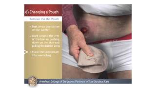 ColostomyIleostomy Changing a Pouch [upl. by Matthaeus368]