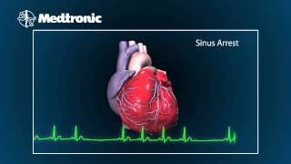 What Is Bradycardia [upl. by Hanonew]