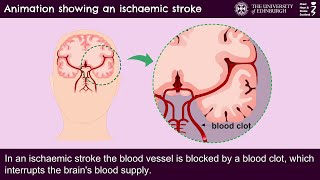 Animation showing an ischaemic stroke [upl. by Ailee]